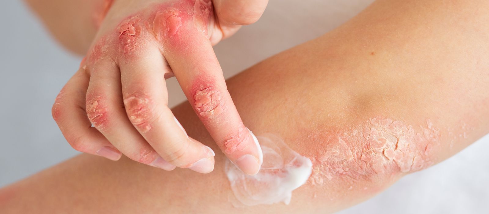 https://www.dobrezdravie.sk/image/cache/catalog/clanky/ekzem-psoriaza-1600x700-1600x700.jpg https://www.dobrezdravie.sk/image/cache/catalog/clanky/ekzem-psoriaza-1600x700-1600x700.jpg
